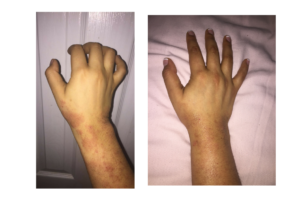 eczema, before and after, rash , natural healing