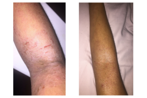 eczema, before and after, rash