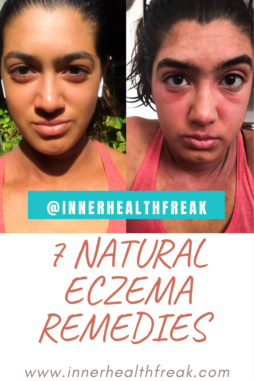 7 Natural Eczema Remedies 