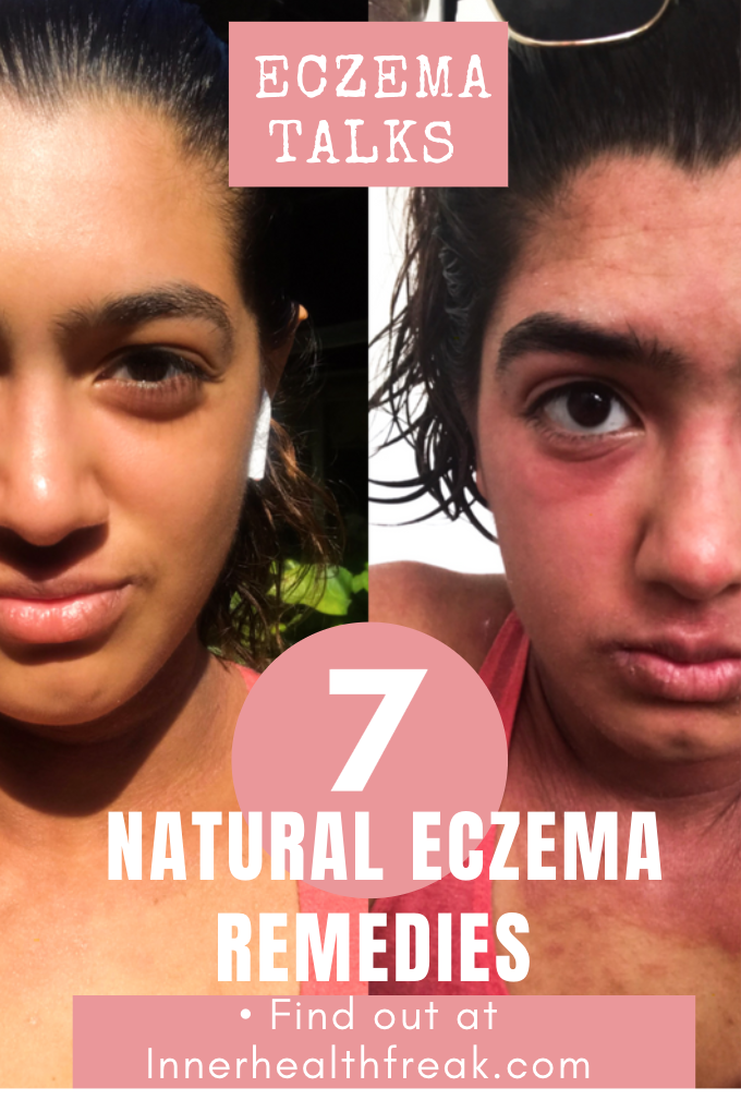 7 Natural Eczema Remedies 