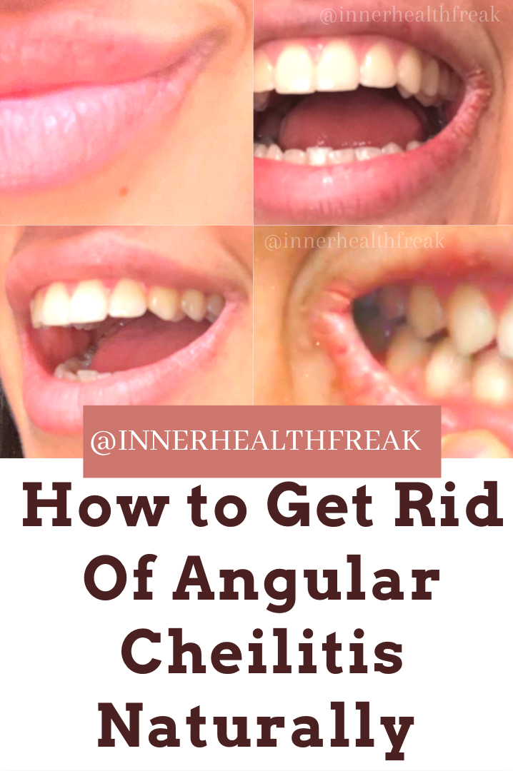 How to get rid of Angular Cheilitis Naturally 