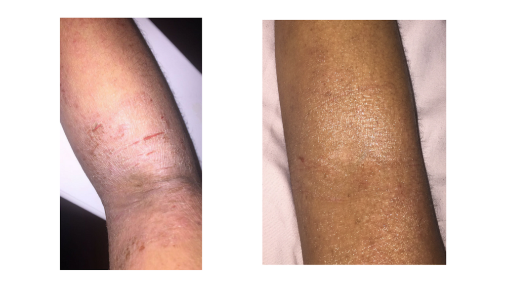 Eczema Before and After how to control eczema