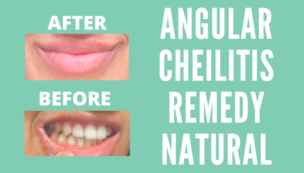 Angular Cheilitis Remedy Natural Inner Health Freak