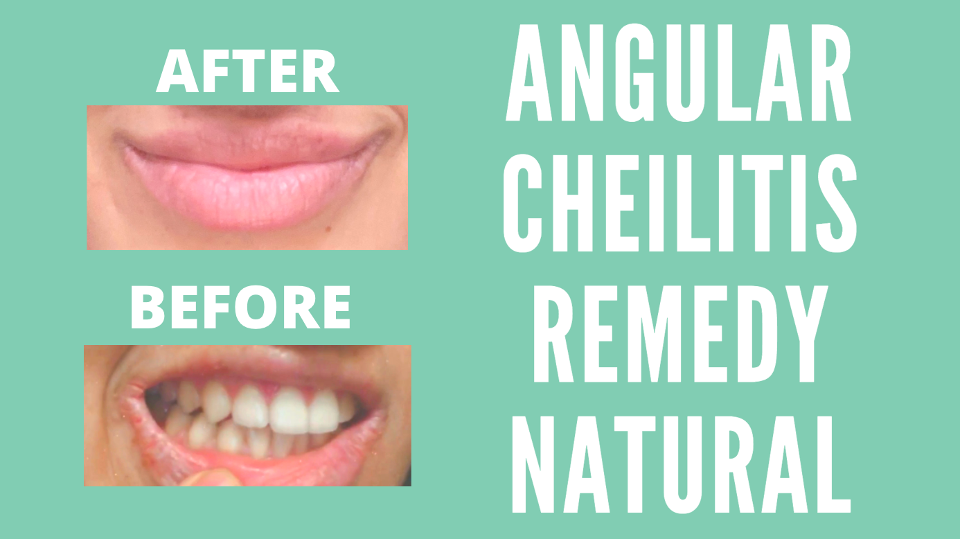 Angular Cheilitis Remedy Natural